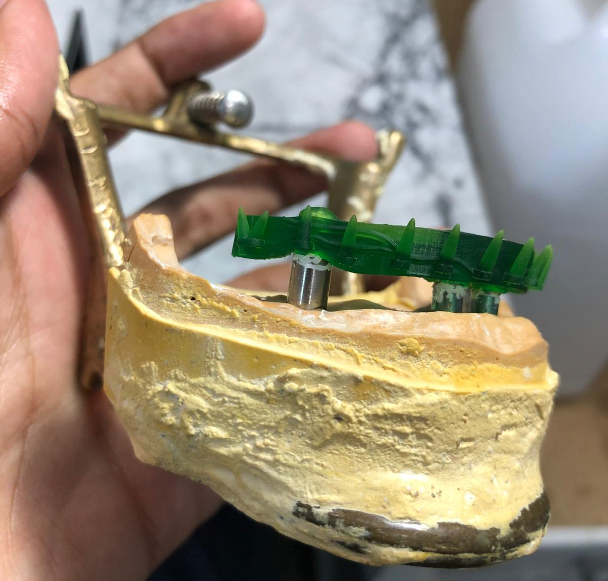 Implant Prosthetics